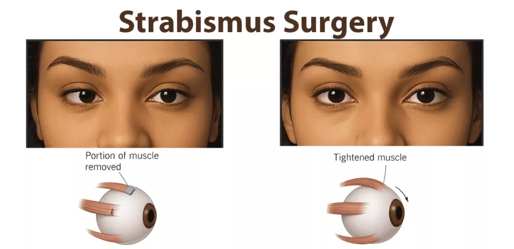 Squint Surgery Signs and Symptoms