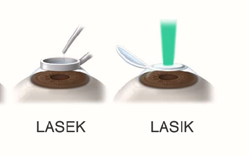 lasik-lasek which Procedure Is Better for You?