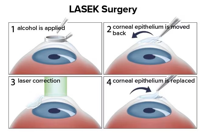 What Is LASEK Eye Surgery?