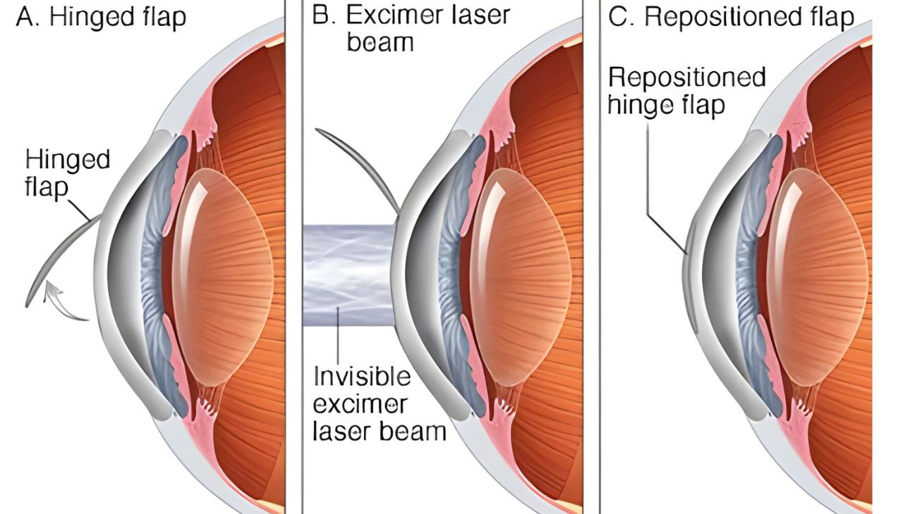 What Is LASIK Eye Surgery?