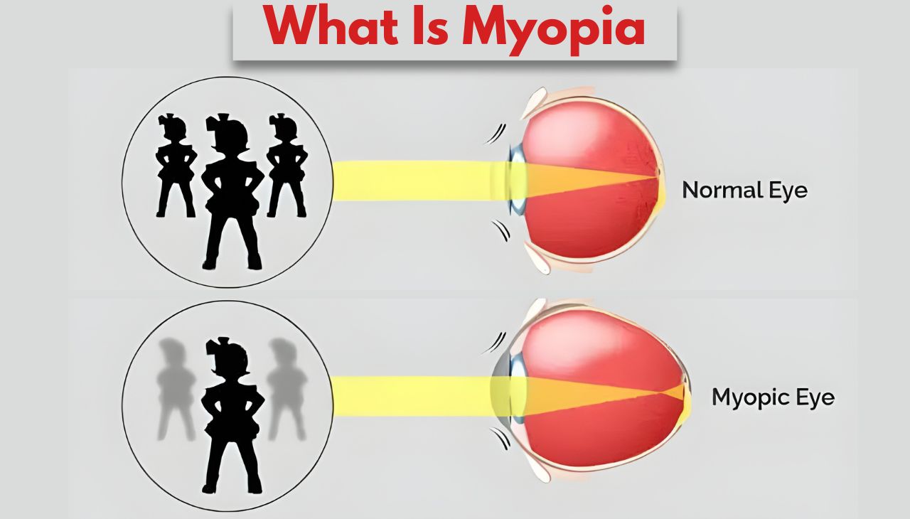What Is Myopia and When Does It Become Risky?