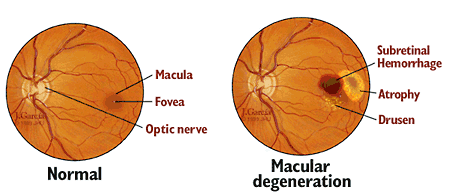 Age-related Macular Degeneration (AMD)