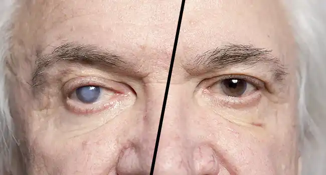 Who Should Consider Bladeless Cataract Surgery?