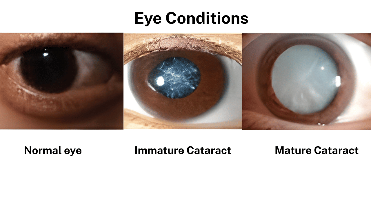 Available Treatment Options for immature cataract