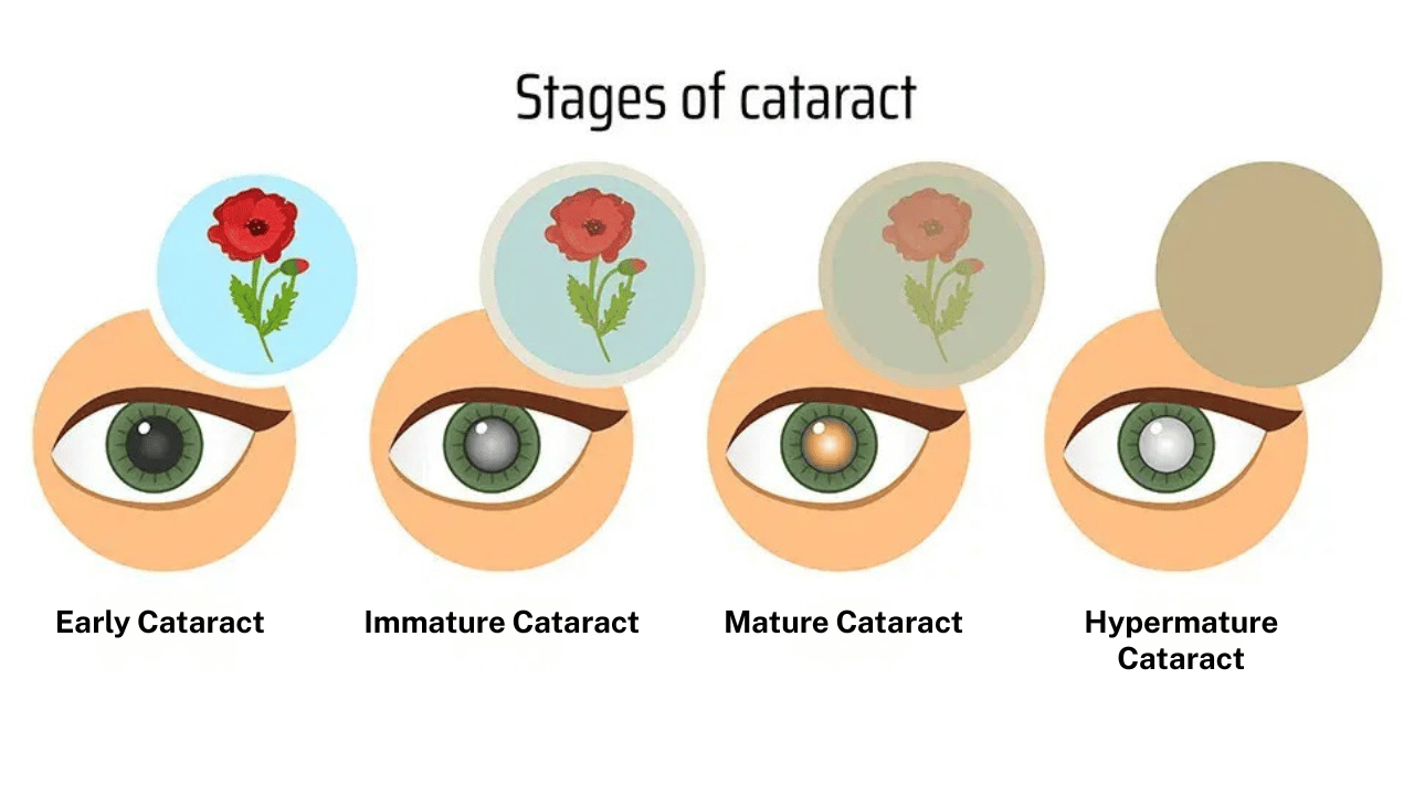 Stages of Immature Cataract Development