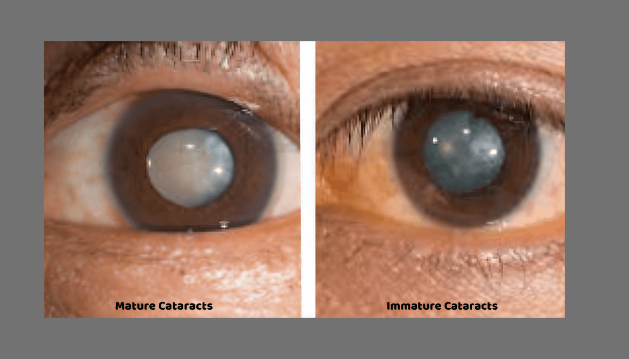 What Is an Immature Cataract