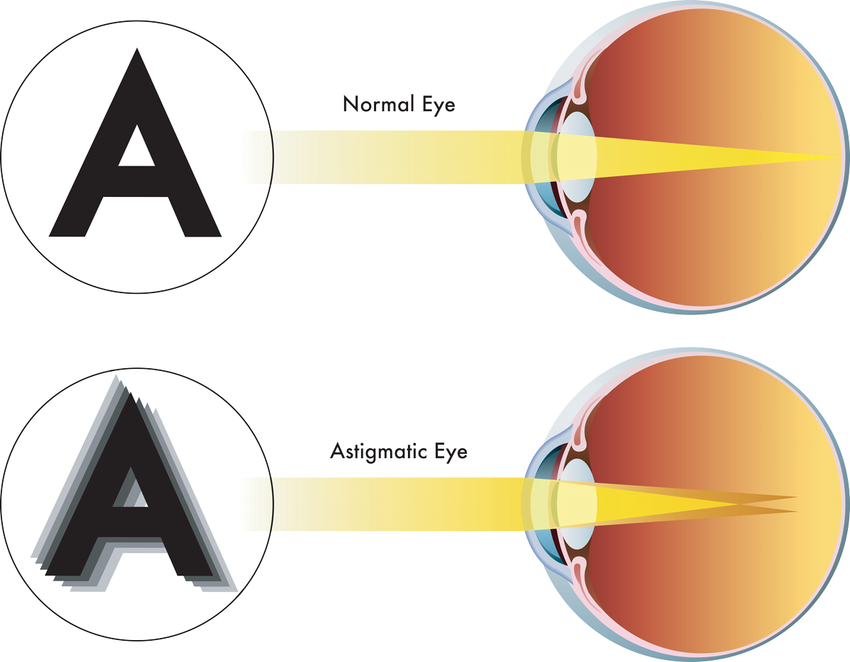 Understanding Astigmatism and Its Symptoms