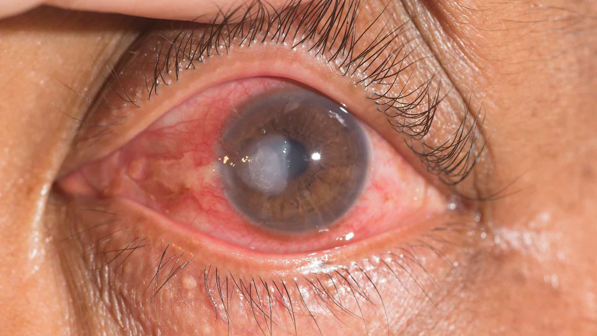 Understanding Corneal Ulcers