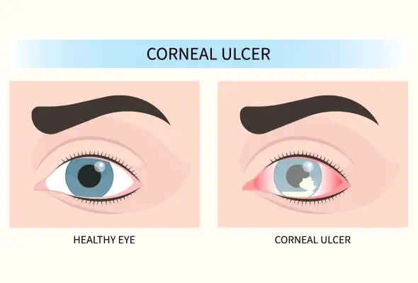 Treatment Options for Corneal Ulcers