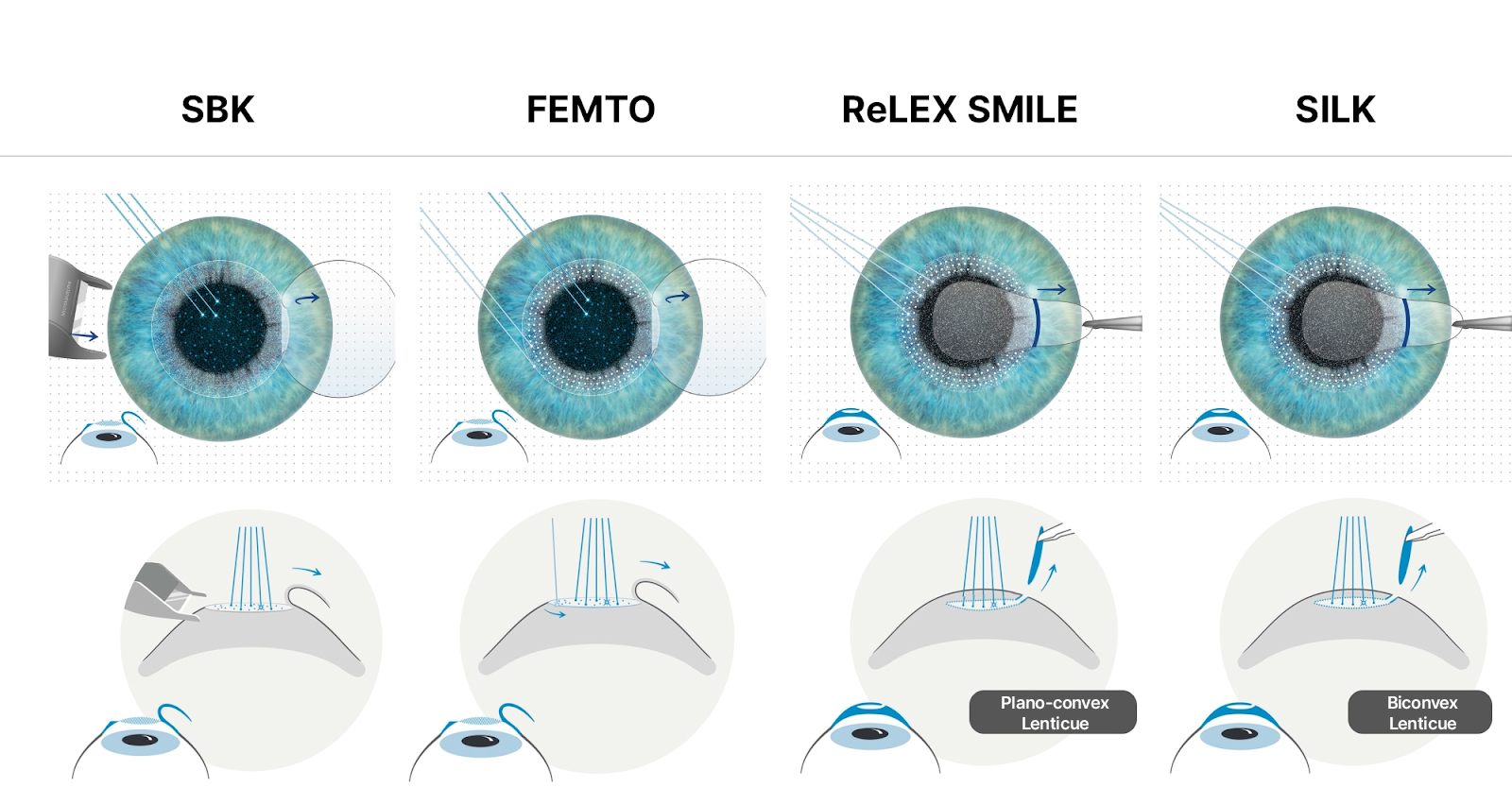 Treatment Options: Why Choose the SILK Procedure?