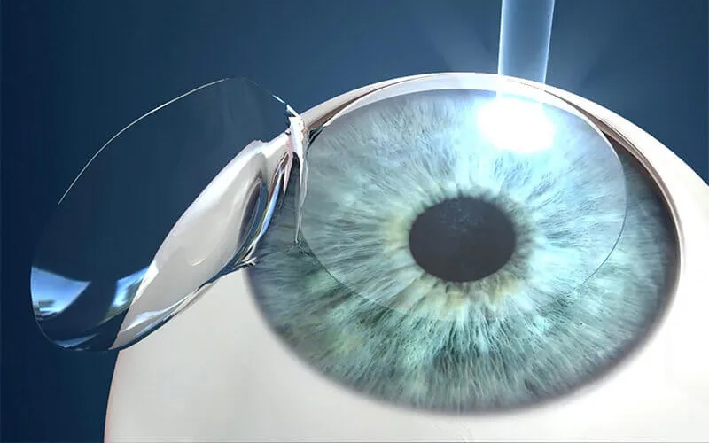 Basics of LASIK Surgery