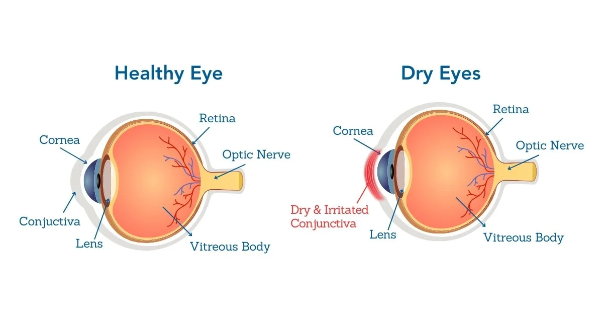 Treatment Options for Dry Eye Syndrome