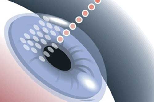 Advanced LASIK Techniques and Options