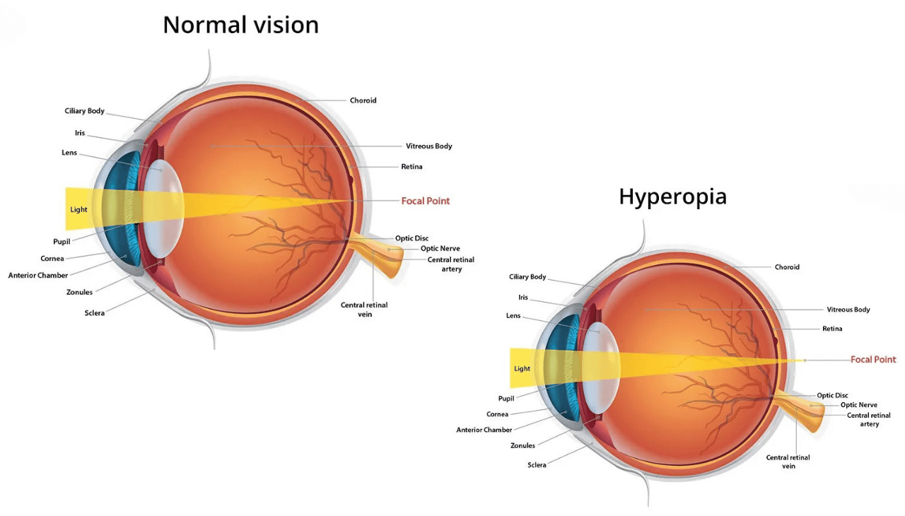 Treatment and Solutions for Hypermetropia