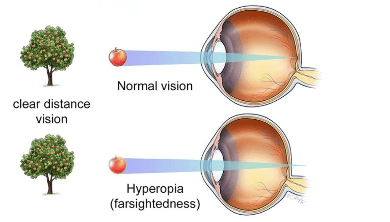 Understanding Hypermetropia