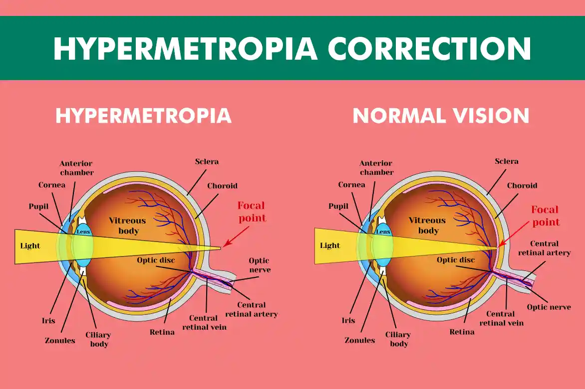 What is Hypermetropia?