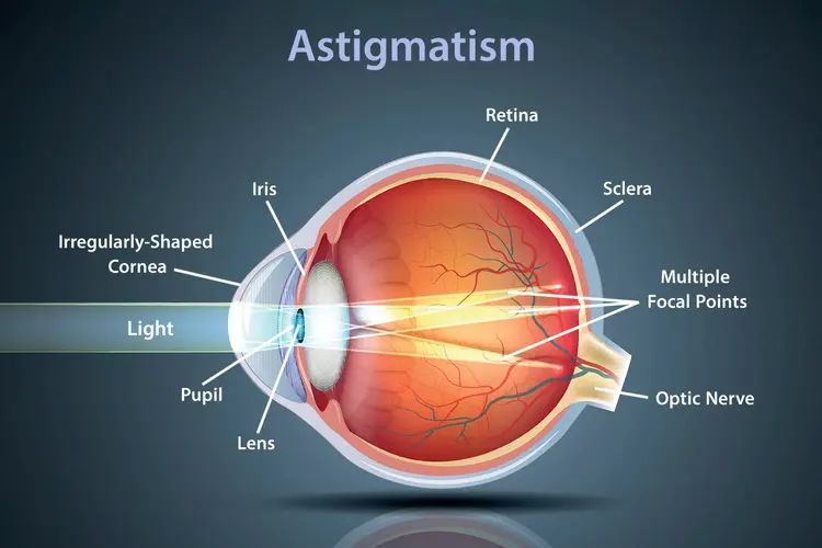 What is Astigmatism?
