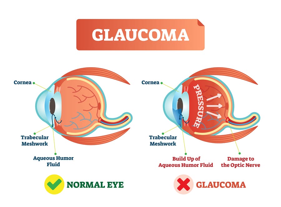 Understanding Glaucoma: The Basics