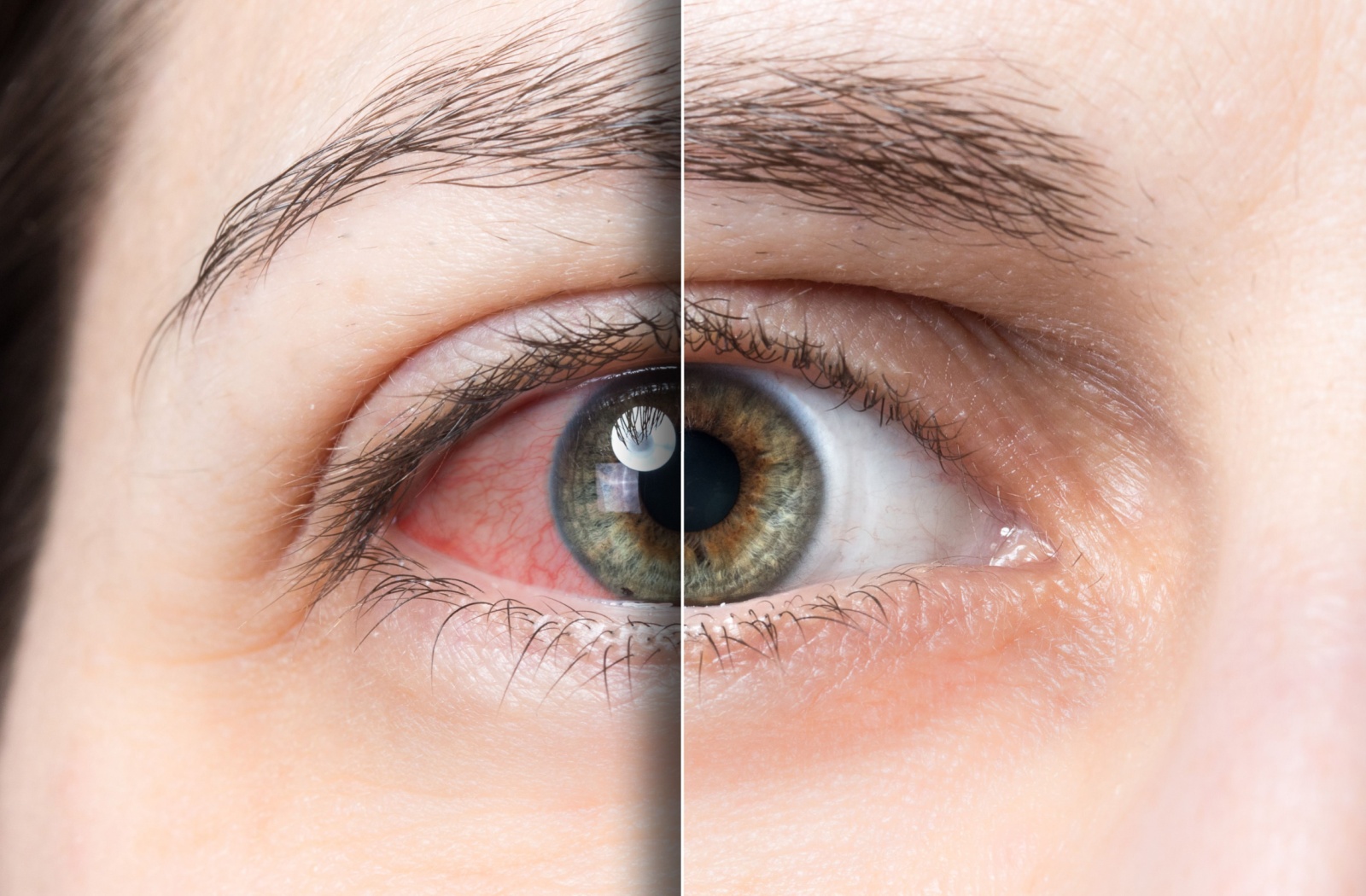 Understanding Dry Eye Syndrome and IPL Therapy