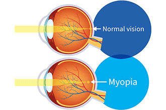 What is Myopia?