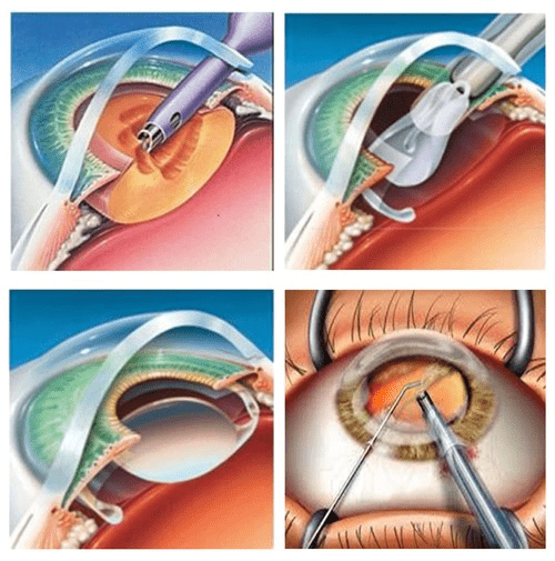 What is MICS Cataract Surgery?