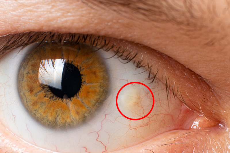 What is Pingueculitis?
