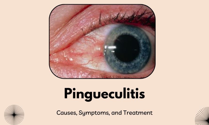 Pingueculitis: What It Is, Causes, Symptoms, and How to Treat It