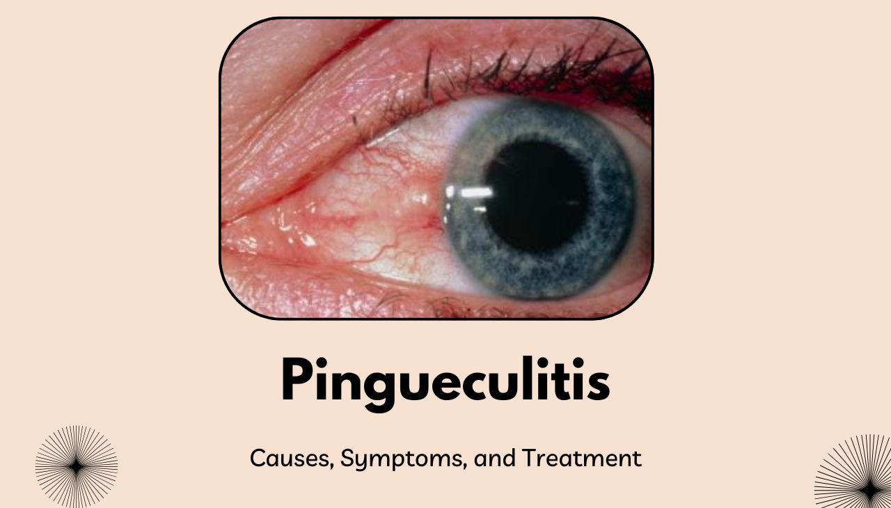 Pingueculitis: What It Is, Causes, Symptoms, and Treatment