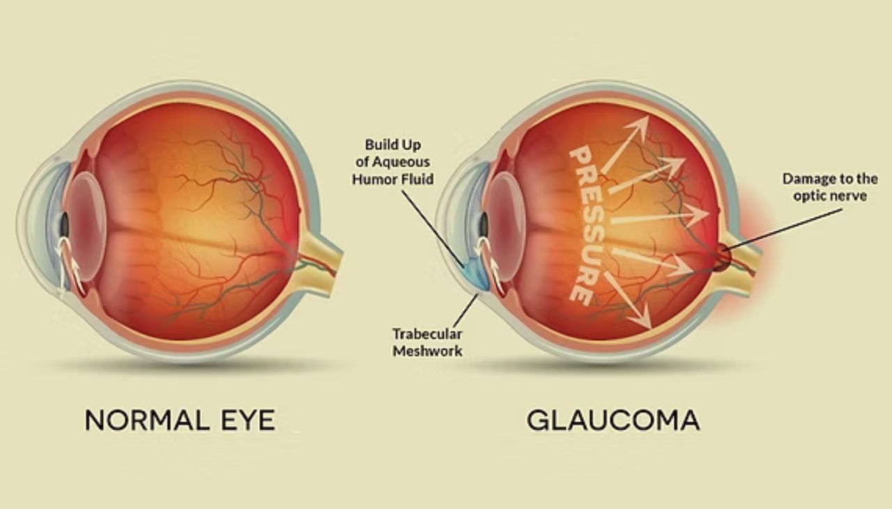 understanding-eye-pressure-glaucoma