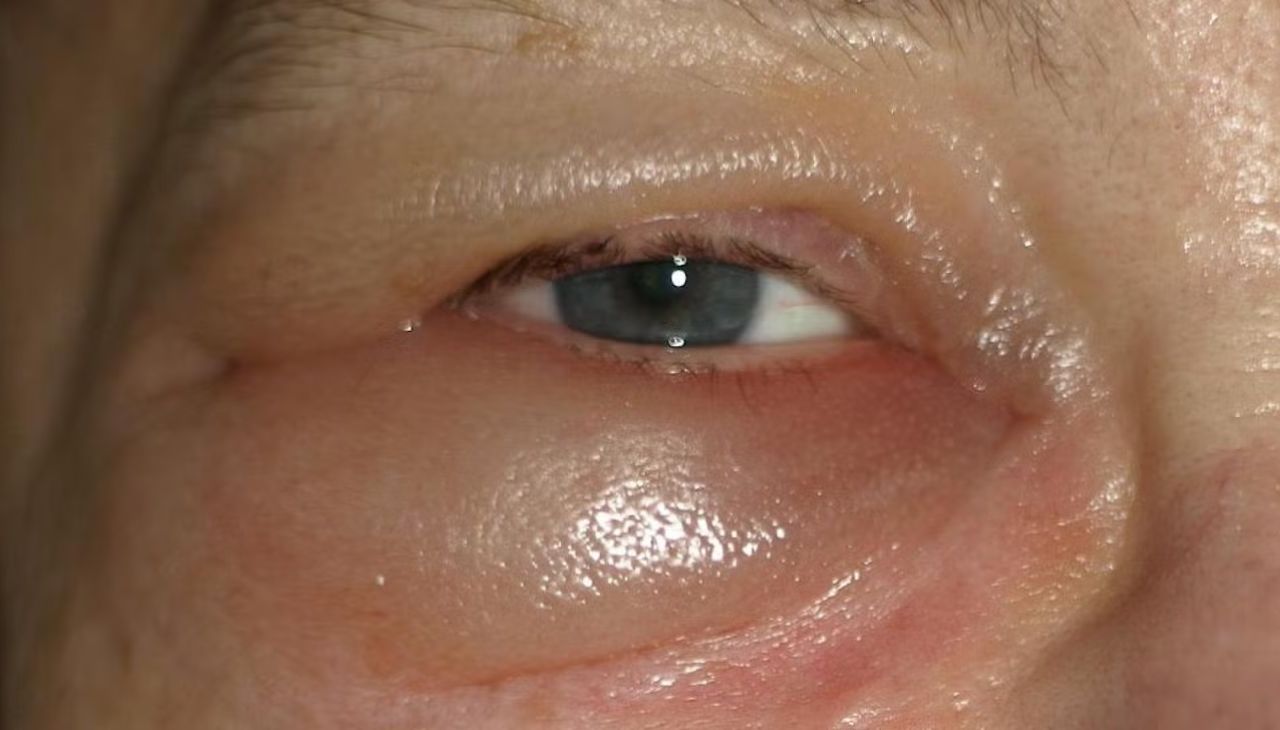 Understanding Eye Swelling: What It Is
