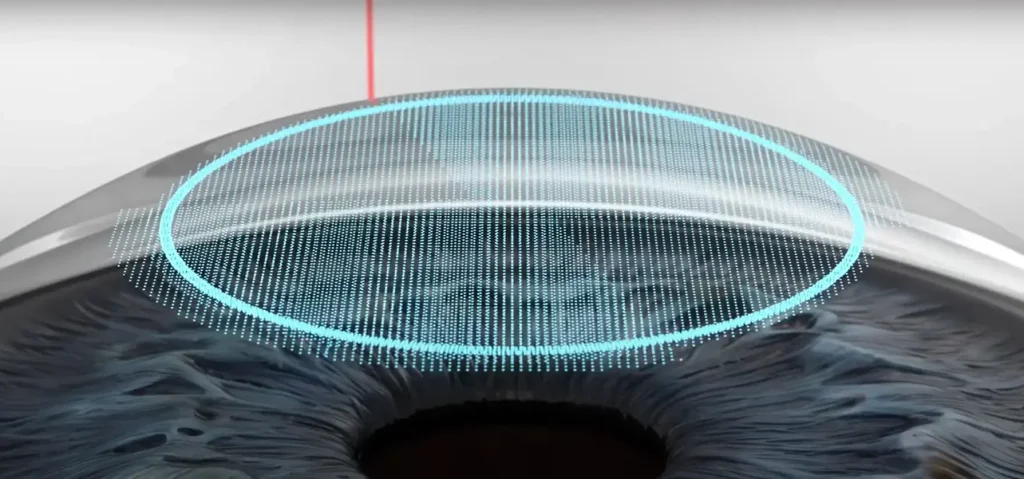 What is Advanced SILK Laser Eye surgery?