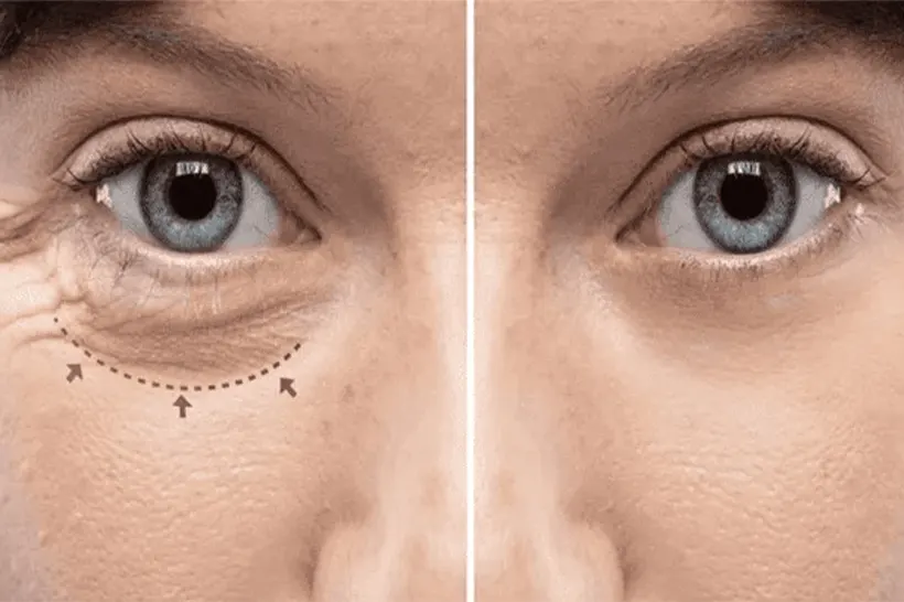 What is Oculoplasty Treatment?