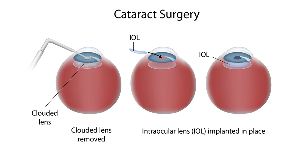 Cataract Surgery in Mumbai