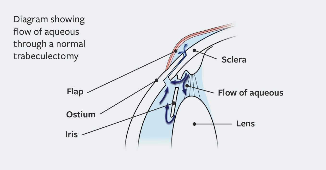 What Is Trabeculectomy Surgery?