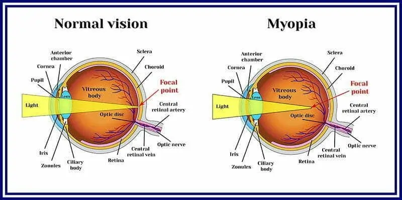 Why Is Myopia Increasing Globally?