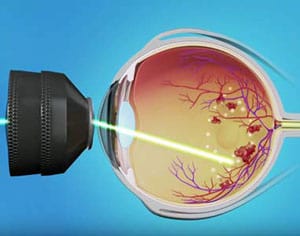 What Is Retinal Laser Surgery?