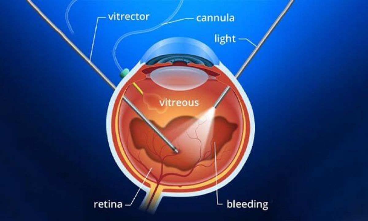 What Is Vitrectomy Surgery?