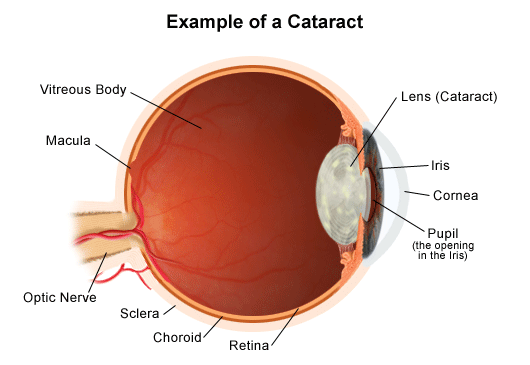 Cataract in Diabetic Patients