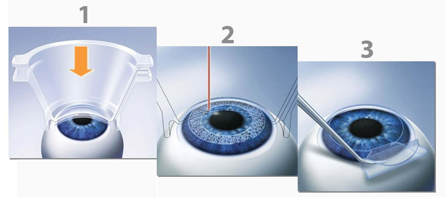 Bladeless Lasik Surgery at Laxmi Eye Hospitals and Institute in Navi Mumbai, centres at Panvel, Kharghar, Kamothe and Dombivali.