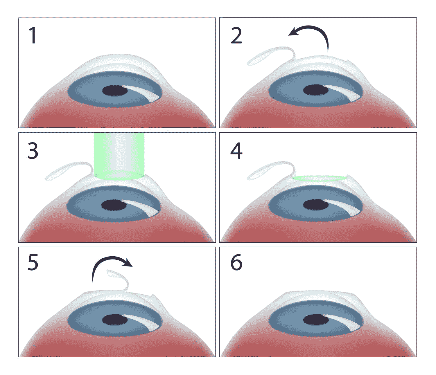 Contoura Vision LASIK Surgery procedure with Laxmi Eye Hospital in Navi Mumbai, Panvel, Kharghar, Kamothe and Dombivali