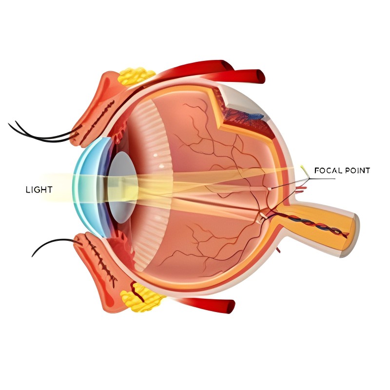 Bladeless Lasik Surgery at Laxmi Eye Hospitals and Institute in Navi Mumbai, centres at Panvel, Kharghar, Kamothe and Dombivali.