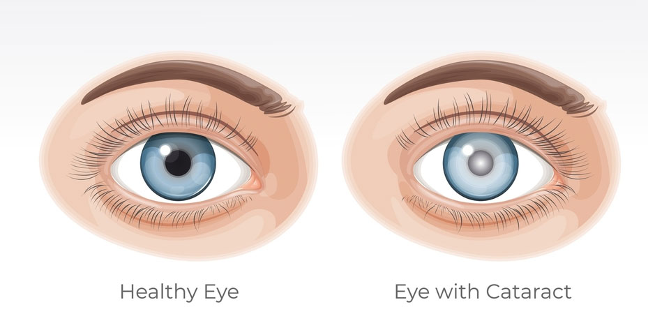 Cataract eye Surgery at Laxmi Eye Hospitals and Institute in Navi Mumbai, best eye care centres at Panvel, Kharghar, Kamothe and Dombivali.