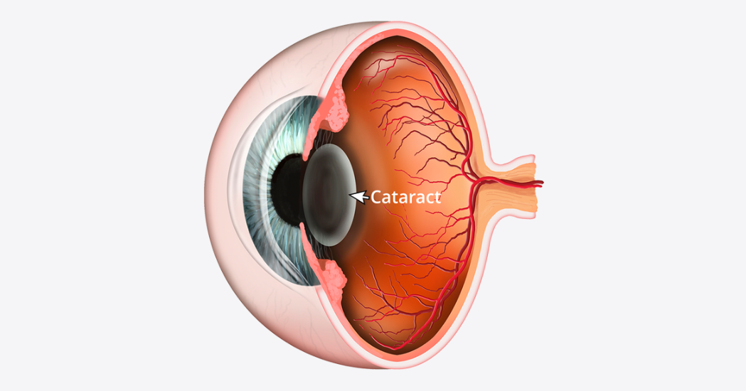 Cataract eye Surgery at Laxmi Eye Hospitals and Institute in Navi Mumbai, best eye care centres at Panvel, Kharghar, Kamothe and Dombivli.