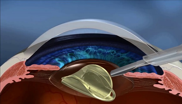 Cataract surgery cost in Navi Mumbai at Laxmi Eye Hospital