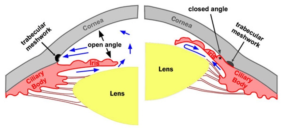 Closed Angle Glaucoma treatment at Laxmi Eye Hospitals and Institute in Navi Mumbai, centres at Panvel, Kharghar, Kamothe and Dombivali.