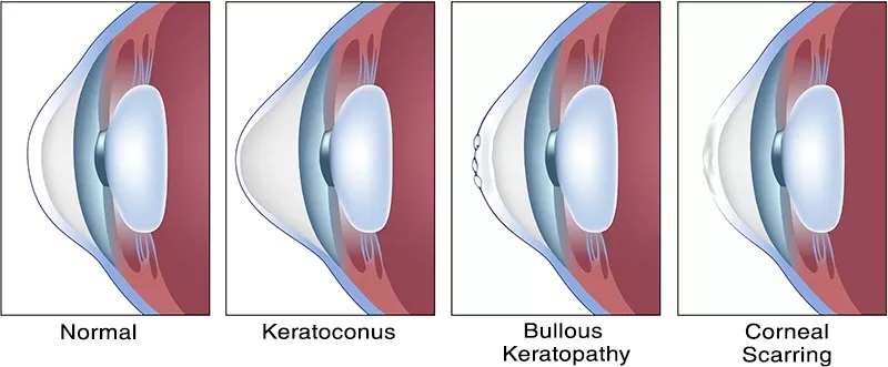 Cornea Disease Treatment at Laxmi Eye Hospitals and Institute in Navi Mumbai, centres at Panvel, Kharghar, Kamothe and Dombivali.