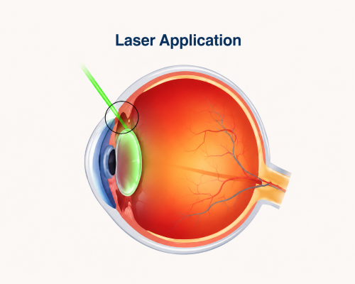 Laser Glaucoma Surgery Alternatives Approach
