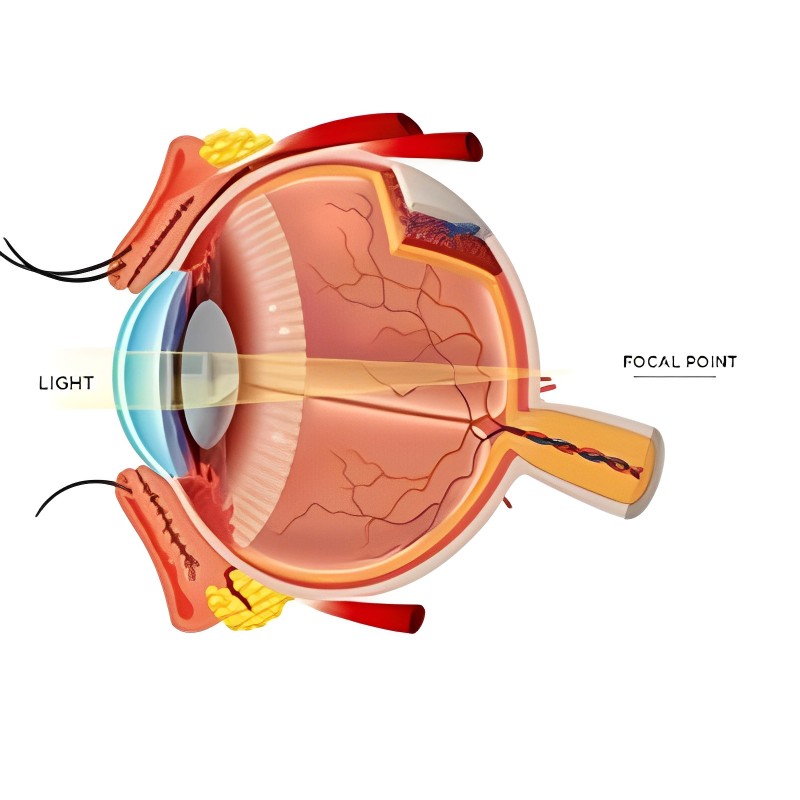 Bladeless LASIK Surgery at Laxmi Eye Hospitals and Institute in Navi Mumbai, centres at Panvel, Kharghar, Kamothe and Dombivali.