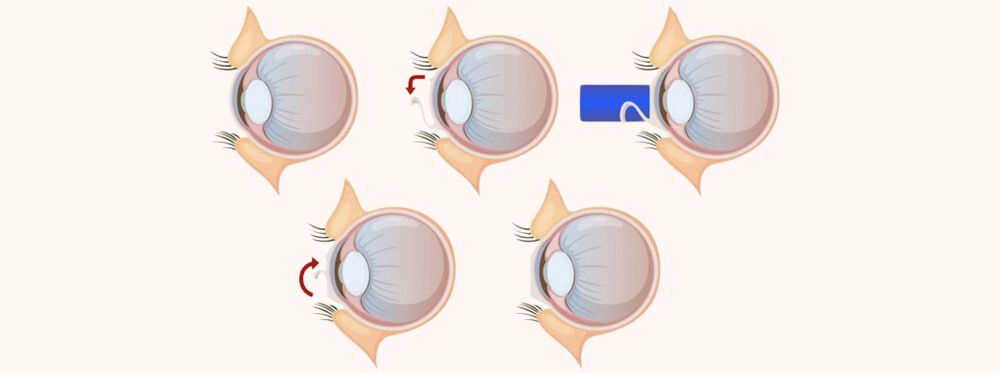 Best LASIK Surgery at Laxmi Eye Hospitals and Institute in Navi Mumbai, centres at Panvel, Kharghar, Kamothe and Dombivali.