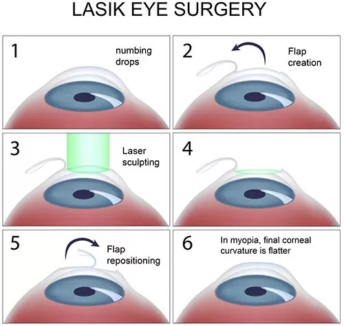 Best LASIK Surgery at Laxmi Eye Hospitals and Institute in Navi Mumbai, centres at Panvel, Kharghar, Kamothe and Dombivali.